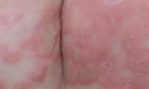 Bé trai 3 tuổi bị giang mai bẩm sinh dù không có triệu chứng