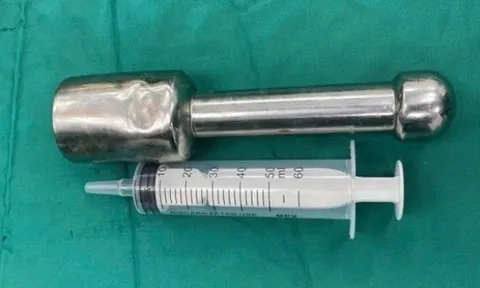 Thiếu niên 15 tuổi mắc kẹt chày kim loại dài 18 cm ở trực tràng