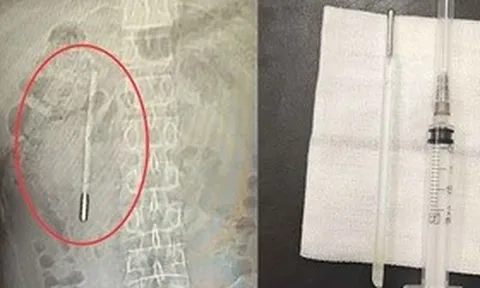 Đau bụng đi khám, người đàn ông sốc nặng khi thấy thứ bên trong