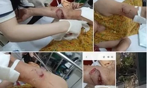 Chó lạ hung hãn tấn công 3 phụ nữ đi tập thể dục