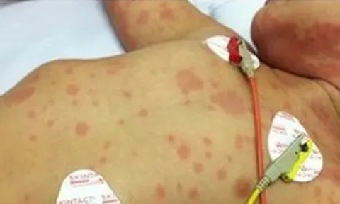 Ca bệnh do "sát thủ 24 giờ" não mô cầu gia tăng: Bác sĩ Bệnh viện Bạch Mai cảnh báo người lớn tuyệt đối không làm 1 việc khi ở gần trẻ