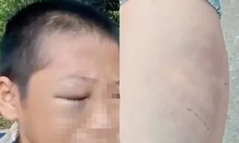 Xôn xao clip bé trai mắt bầm tím, khóc kêu cứu vì nhiều lần bị đánh đập khi ở cùng bố và vợ mới