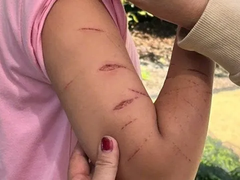 Chủ tịch UBND tỉnh Cà Màu chỉ đạo khẩn vụ nữ sinh lớp 5 bị gây thương tích