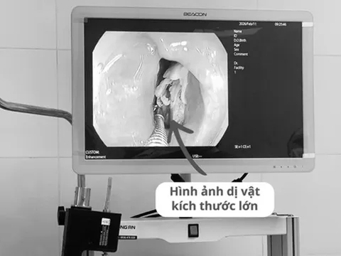 Bệnh nhân 16 tuổi đau họng kéo dài, bác sĩ phát biện bí mật "đáng sợ" bên trong