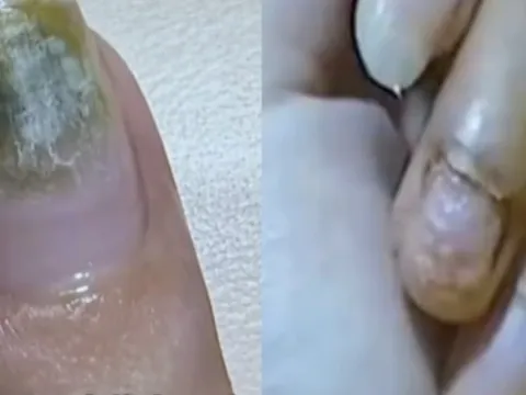 Trung Quốc: Tiệm nail khiến nhiều người nhiễm HPV do khử trùng dụng cụ làm móng qua loa