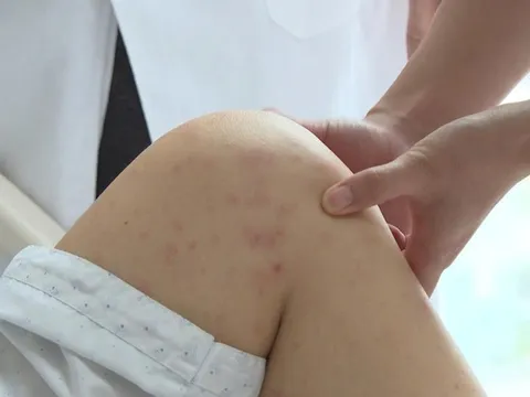 Hà Nội: Cô giáo mầm non viêm phổi do mắc thủy đậu, sai lầm vì "tôi nghĩ thủy đậu là bệnh của trẻ em"