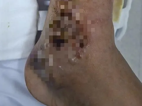 Đắp thuốc, một người đàn ông suýt mất chân