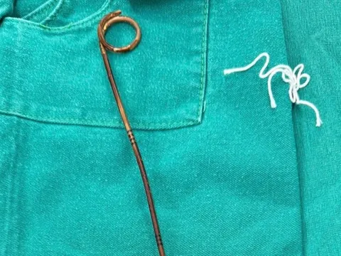 Quên thiết bị y tế trong bụng suốt hai năm