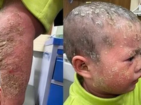 'Con đau lắm, bố ơi'-tiếng khóc xé lòng của bé gái 3 tuổi có làn da như 'lửa thiêu'