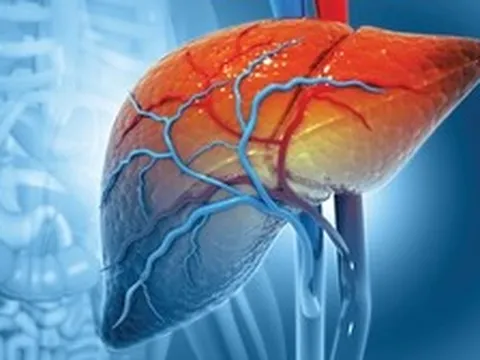 Ung thư gan tại Việt Nam gia tăng báo động: Kiểm soát được 3 thứ này, giảm được 2/3 số ca mắc