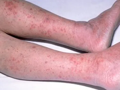 Căn bệnh là "sát thủ thầm lặng", người khỏe ngã gục chỉ trong 24 giờ: Bác sĩ chỉ cách phòng tránh