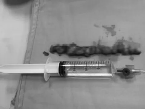 Đau lưng kéo dài tưởng xương khớp, người phụ nữ tá hỏa khi biết mình mắc bệnh nguy hiểm