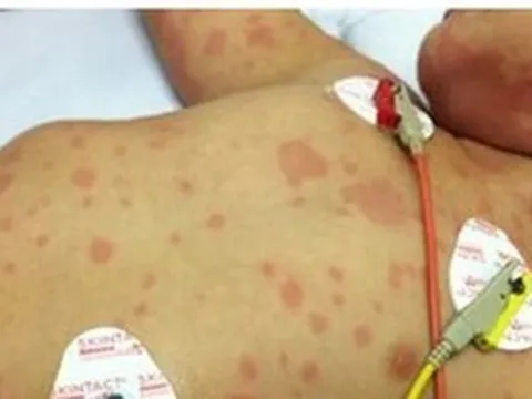 Ca bệnh do "sát thủ 24 giờ" não mô cầu gia tăng: Bác sĩ Bệnh viện Bạch Mai cảnh báo người lớn tuyệt đối không làm 1 việc khi ở gần trẻ