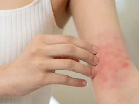 Luôn cảm thấy ngứa, cô gái 26 tuổi "sốc" khi biết mình mắc căn bệnh này