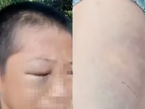 Xôn xao clip bé trai mắt bầm tím, khóc kêu cứu vì nhiều lần bị đánh đập khi ở cùng bố và vợ mới