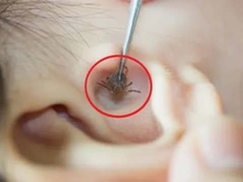 Bé 2 tuổi đau tai bất thường, bố mẹ "sốc" khi bác sĩ gắp ra thứ "đáng sợ" bên trong